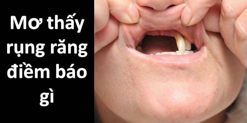 Mơ rụng răng là điềm báo thường xuất hiện